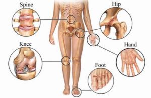 a csípőízület artrózisának tünetei és kezelése terápiás gyakorlatok a könyökízület fájdalmára
